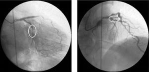 Diagnostic coronary angiography in right anterior oblique 20°, caudal 20° and right anterior oblique 10°, cranial 40° views, showing angiographic lesions corresponding to critical stenosis in the proximal left anterior descending artery and severe stenosis in the mid circumflex artery.