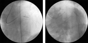 Percutaneous coronary intervention with direct stenting of the lesions observed on diagnostic angiography: 3mm×12mm DRIVER stent in the proximal left anterior descending artery (left) and 3mm×15mm DRIVER stent in the mid circumflex artery (right).