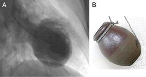 (A) Ventriculography showing cardiac morphology in systole in a patient with takotsubo cardiomyopathy and LVEF of 27%; (B) a takotsubo – a pot (tsubo) for catching octopus (tako).