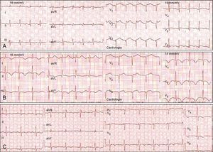 Serial electrocardiograms in a patient with takotsubo cardiomyopathy mimicking anterior myocardial infarction. (A) Acute phase: sinus tachycardia and ST-segment elevation in V2–V6; (B) subacute phase (2nd day): T-wave inversion in I, II, III, aVF, and V3–V6; (C) subacute phase (5th day): beginning of normalization and reduction in T-wave amplitude.