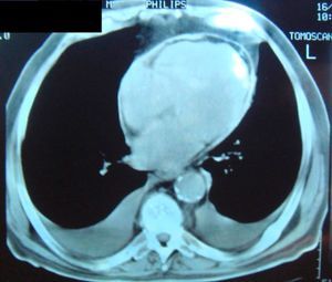 Chest CT showing pericardial thickening and calcification.