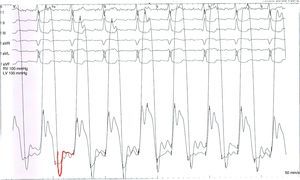 Ventricular pressures with left ventricular dip-and-plateau pattern.
