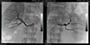 Final renal angiogram following radiofrequency ablation.