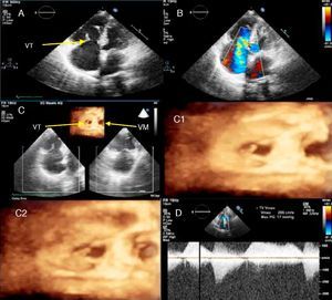 Carcinoid involvement of the tricuspid valve: (A) apical 4-chamber view in systole, revealing right chamber dilatation, thickened tricuspid valve leaflets preventing coaptation, fixed in semi-open position; (B) color Doppler echocardiography, showing severe tricuspid regurgitation; (C) three-dimensional echocardiography, comparing the tricuspid and mitral valves, viewed from the ventricular side: (C1) detail in diastole, showing fixed tricuspid valve leaflets, thickened in comparison to mitral valve leaflets; (C2) detail in systole, revealing mitral valve closure and non-closure of the tricuspid valve; (D) color Doppler echocardiography, showing tricuspid regurgitation. VM: mitral valve; VT: tricuspid valve.