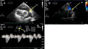 Carcinoid involvement of the pulmonary valve: (A) right ventricular outflow tract, showing thickened pulmonary valve leaflets; (B) color Doppler echocardiography, showing mild pulmonary regurgitation with slightly turbulent diastolic flow; (C) continuous wave Doppler echocardiography, revealing mild pulmonary stenosis. RVOT: right ventricular outflow tract; VP: pulmonary valve.