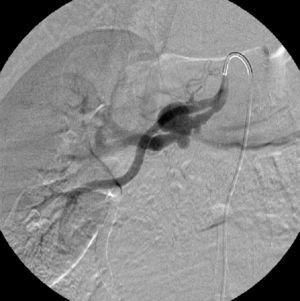 Right renal angiography before stent implantation showing two renal arteries and three saccular aneurysms in the superior artery.