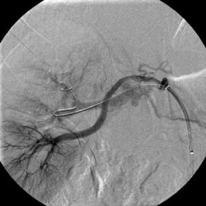Right renal angiography after implantation of a 6×22-mm stent in the superior right renal artery.