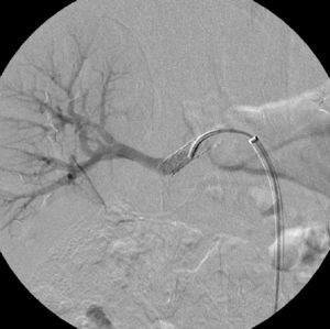 Selective right renal angiography after stent implantation in the superior right renal artery showing exclusion of the aneurysms.