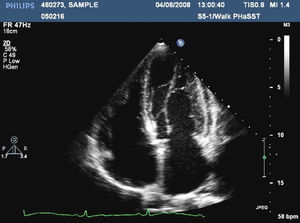 Apical 4-chamber view of the anomalous insertion of the papillary muscles in 2D transthoracic echocardiography.