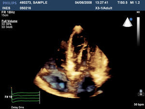 Real-time 3D echocardiography demonstrating the low insertion of the anterolateral papillary muscle in apical 4-chamber view.