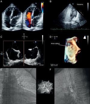 (A) Transthoracic echocardiography; (B) contrast echocardiography; (C) 3D real-time transesophageal echocardiography; (D) 3D off-line reconstruction of the PFO; (E and F) cardioscopy.