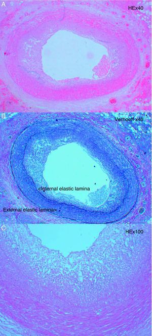 Histological images of lesions typical of cardiac allograft vasculopathy, with concentric intimal proliferation (A and B). Panel C shows numerous inflammatory cells in the lesion.