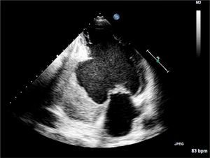 Transthoracic echocardiogram in apical two-chamber view, showing a large aneurysmal sac in the basal and mid segments of the inferior wall containing a thrombus. Myocardial rupture cannot be confirmed.