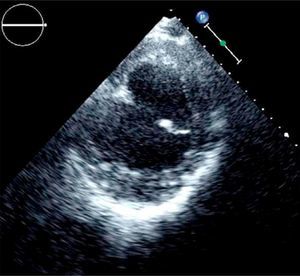 Transthoracic echocardiogram, short-axis view of the left ventricle, showing a large aneurysmal sac in posteroinferior location.