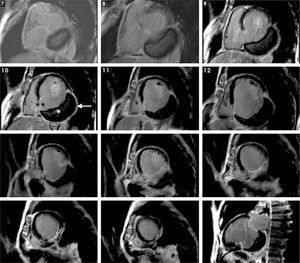 Delayed enhancement cardiac magnetic resonance images, in short-axis view from the base to the apex and two-chamber view (right bottom corner), showing transmural infarction of the inferior basal and mid segments. The basal inferior segment of the left ventricular wall consists of a giant thrombus (*), infarcted myocardium (**) and pericardium (arrow), confirming a pseudoaneurysm.