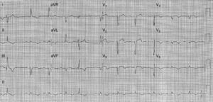 Admission EKG showing sinus rhythm, intraventricular conduction abnormality – incomplete left bundle branch block pattern – and ST segment elevation in V1–V3.