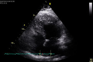 Transthoracic echocardiogram showing pronounced left ventricular non-compaction in the apical-lateral wall.