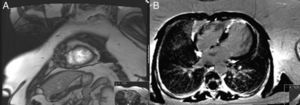 (A) Cardiac magnetic resonance imaging showing left ventricular hypertrabeculation, mainly in the apical and medial segments, with moderate systolic dysfunction; (B) cardiac magnetic resonance imaging showing transmural apical late enhancement compatible with myocardial infarction.