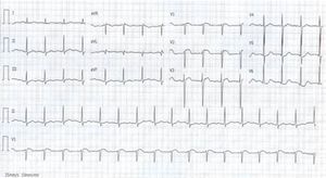 Electrocardiogram showing slight ST-segment elevation in leads V1–V3.