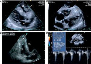 Transthoracic echocardiography (A–D), showing an infiltrating mass in the right ventricle (arrow), involving the entire apical region, interventricular septum and free wall, but not causing significant right ventricular outflow tract obstruction (D). AD: right atrium; AE: left atrium; SIV: interventricular septum; VD: right ventricle; VE: left ventricle.