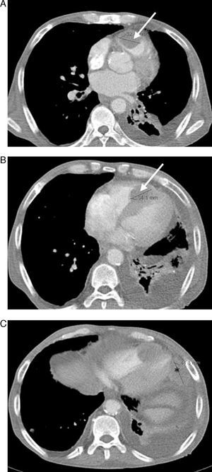 Computed tomography showing a right ventricular mass (arrow), infiltrating the free wall (A) and interventricular septum (B), as well as a mass (*) attached to the pericardium adjacent to the left ventricle (C).