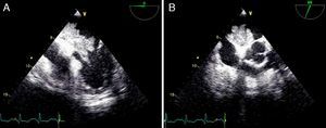 Two-dimensional transesophageal echocardiogram in transverse mid 4-chamber view (A) and transverse basal (B) views, showing a coral-like left atrial mass prolapsing into the left ventricle during diastole.