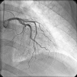 Coronary angiography showing no significant lesions in the coronary tree.