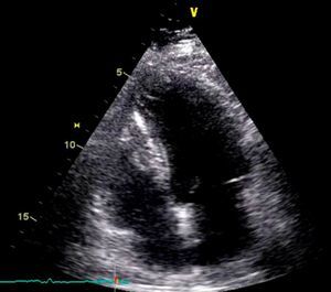 Two-dimensional transthoracic echocardiogram in apical 4-chamber view after resection of the myxoma.
