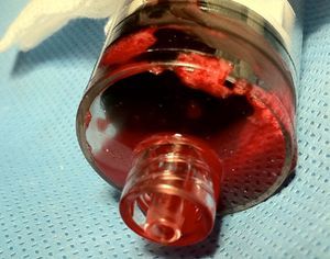 Macroscopic evidence of thrombotic material in the aspiration syringe.