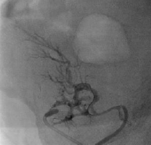 Perfusion in the renal artery graft after thrombus aspiration.