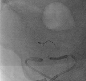 Balloon angioplasty of the transplant renal artery.