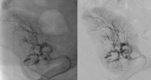 Perfusion in the renal artery graft after balloon angioplasty.