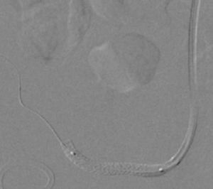 Implantation of stent in the renal artery graft.