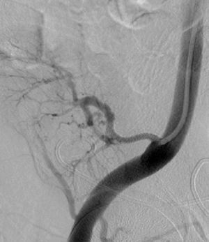 Angiogram of the graft after stent angioplasty.