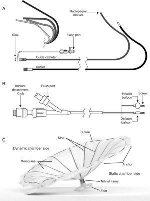 Components of the Parachute device (detailed description in text). (A) Guide catheter and dilator; (B) access system; (C) the Parachute implant.