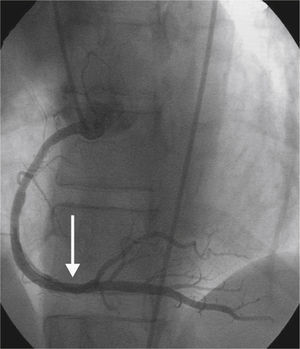 Coronary angiogram of the right coronary system in left anterior oblique projection demonstrating resolution of the spasm of the distal right coronary artery (white arrow).