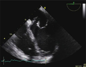 Transesophageal echocardiography showing anterior mitral valve leaflet rupture.