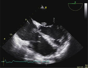 Transesophageal echocardiography showing large vegetations on the anterior mitral valve leaflet and septal tricuspid leaflet.