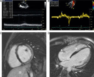 (A) Transthoracic echocardiogram in parasternal view depicting a dilated left ventricle with moderately reduced ejection fraction. (B) Tissue Doppler imaging of lateral mitral inflow velocities, with an E/e′ ratio of 5.3, suggestive of normal filling pressures. (C and D) Cardiovascular magnetic resonance images with late gadolinium enhancement showing typical subepicardial inferolateral fibrosis (white arrows), also involving the mid-septum (dashed arrow), consistent with Becker's cardiomyopathy.