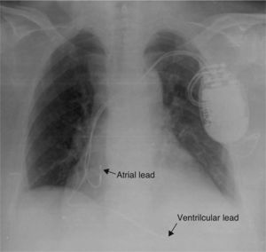 Initial chest X-ray after defibrillator implantation.