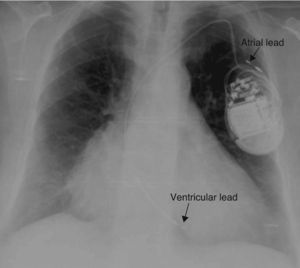Chest X-ray showing displacement of both leads.