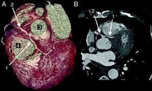 Anomalous origin of the LCA (1) in the right coronary sinus coursing between the aorta (3) and PA (4) in 3D volume-rendered reconstruction (A) and in axial view (B).