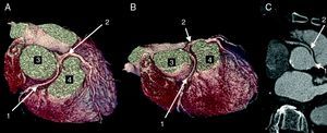 Anomalous origin of the RCA (1) in the left coronary sinus coursing between the aorta (3) and PA (4) in 3D volume-rendered reconstruction (A and B) and in axial view (C).