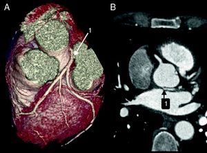 Anomalous origin of the LCA (1) in the non-coronary sinus, in 3D volume-rendered reconstruction (A) and in axial view (B).