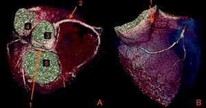 Anomalous origin of the Cx (1) in the proximal RCA (2) coursing between the aorta (3) and left atrium (5) in 3D volume-rendered reconstruction (A and B).