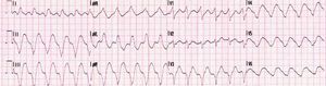 Electrocardiogram showing nonsustained ventricular tachycardia with a heart rate of 180 bpm.
