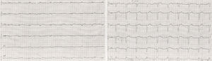 Electrocardiography at presentation. Complete heart block with wide QRS escape rhythm (left bundle branch block aberration, 59bpm).