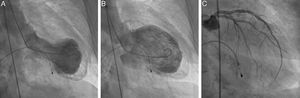 Results of cardiac catheterization. Left ventriculography at end-systole (A) and end-diastole (B) demonstrating typical apical ballooning and double outline apex suggestive of apical thrombus. Results of selective coronary angiography of the left main coronary artery (C) showing no significant stenosis.