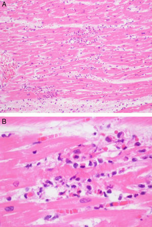 Intermediate (A) and high (B) magnification of myocardium with multifocal infiltrates composed mostly of lymphocytes but also some neutrophils, macrophages, plasma cells and eosinophils, associated with myocyte necrosis and ischemia.