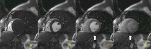 Inversion recovery steady-state free precession sequence, short-axis view. (A-D) Perfusion defect in the inferior wall (arrow). Note the arrival of contrast in the right ventricle (A) and left ventricle (B), and progressive myocardial enhancement (C-D).